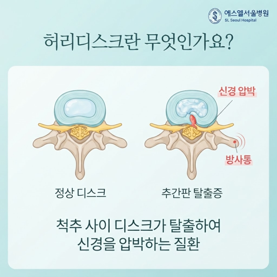 허리디스크 초기증상 관련 이미지 3