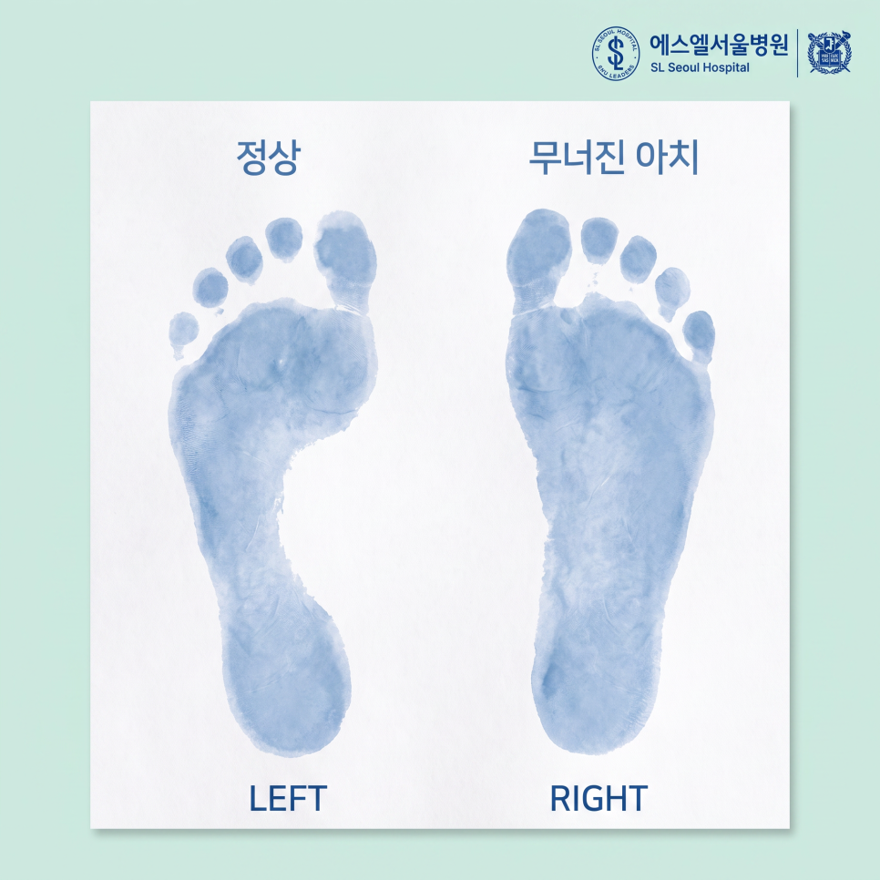 발아치 무너짐 증상 관련 이미지 7